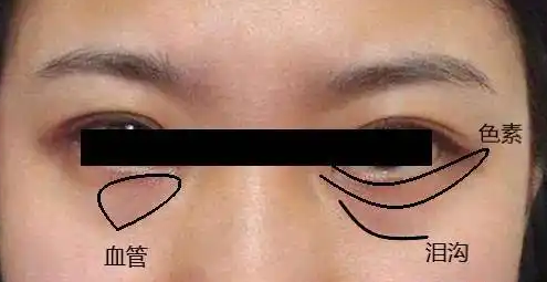 去眼袋手术