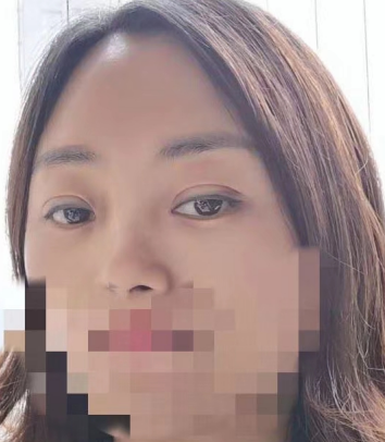 去眼袋手术