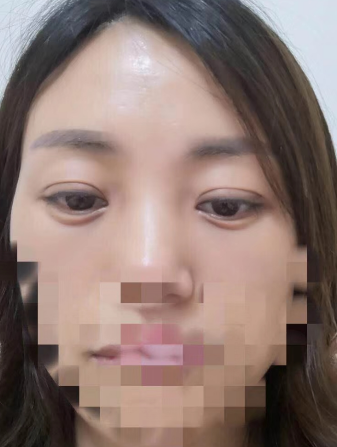 去眼袋手术