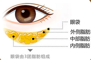 去眼袋手术