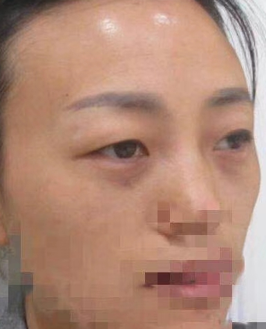 去眼袋手术