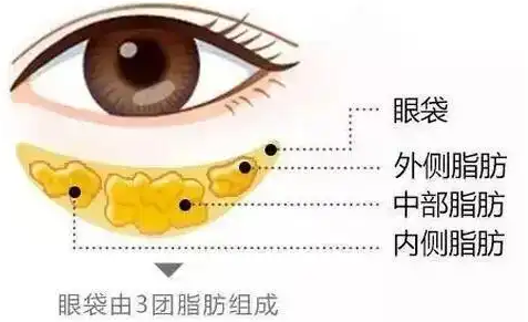 去眼袋手术