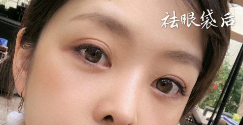 去眼袋手术