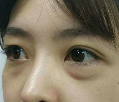 去眼袋手术