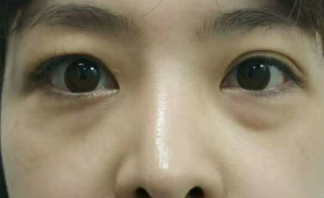 去眼袋手术