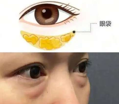去眼袋手术