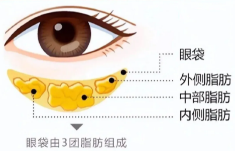 去眼袋手术