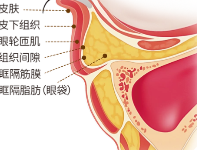 去眼袋手术