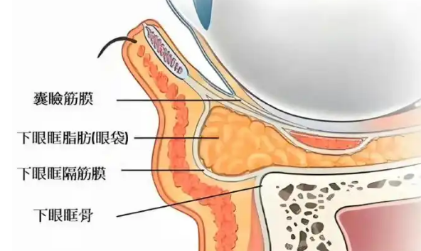 去眼袋手术