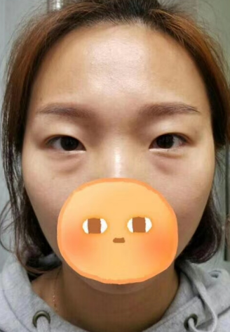 去眼袋手术