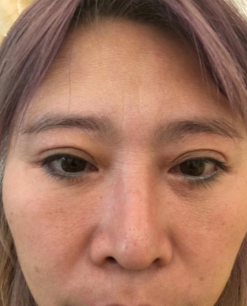去眼袋手术