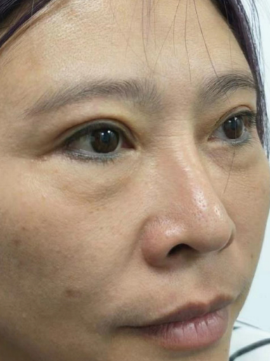 去眼袋手术