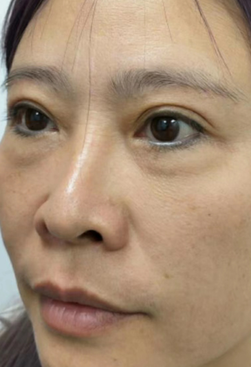 去眼袋手术