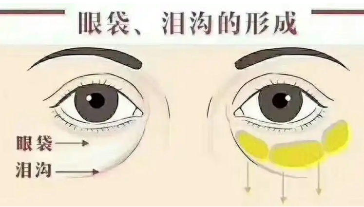 去眼袋手术