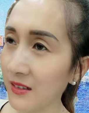 去眼袋手术