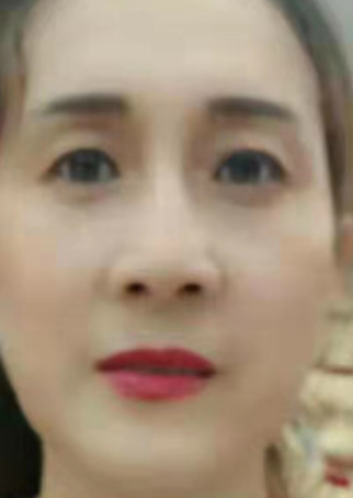 去眼袋手术