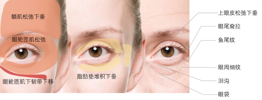 去眼袋手术