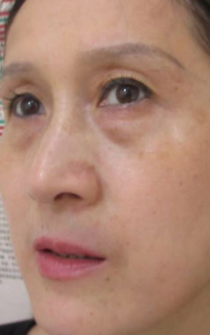 去眼袋手术