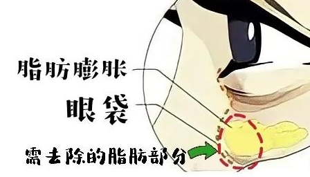 去眼袋手术