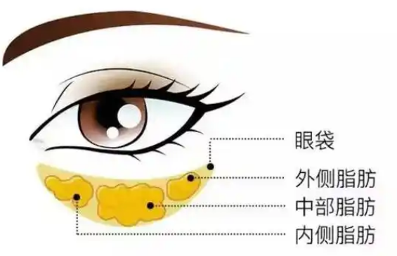 去眼袋手术