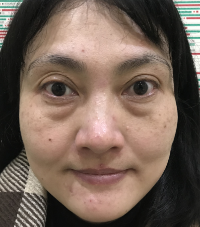 手术去眼袋