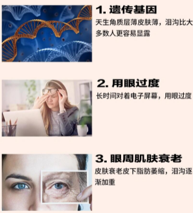 手术去眼袋