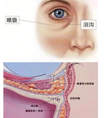 手术去眼袋