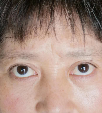 去眼袋手术