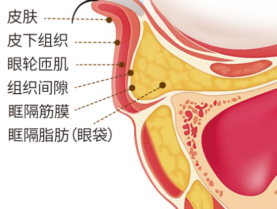 去眼袋手术