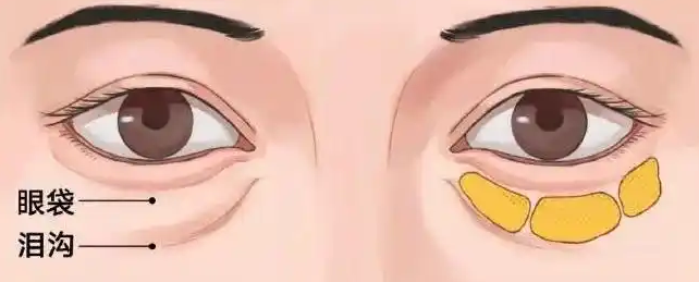 去眼袋手术