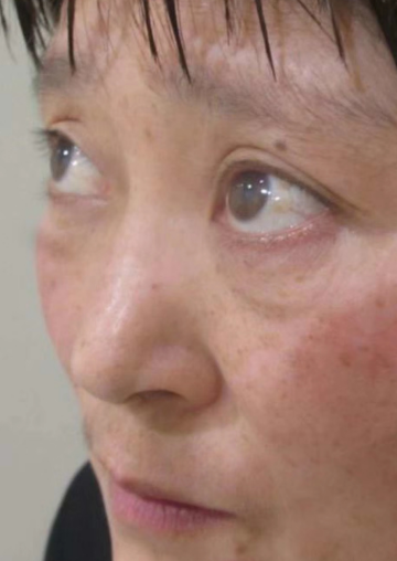 去眼袋手术