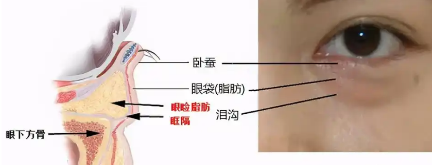 去眼袋手术