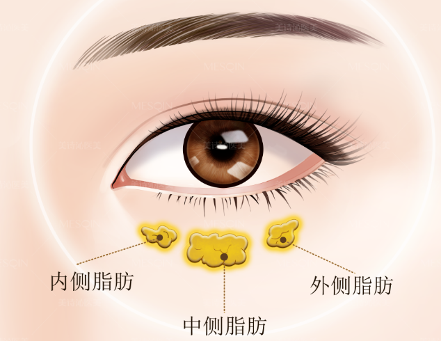 去眼袋手术