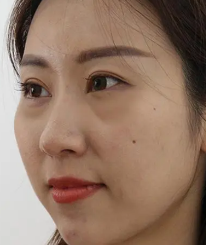 去眼袋手术
