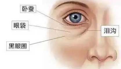 去眼袋手术