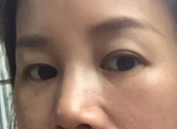 去眼袋手术
