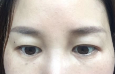 去眼袋手术