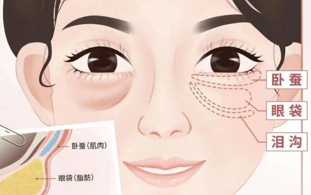 去眼袋手术