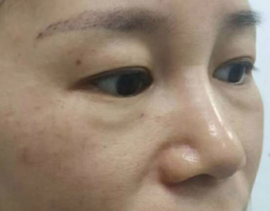 去眼袋手术