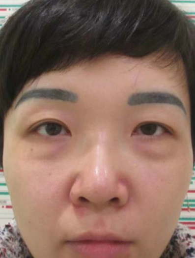 去眼袋手术
