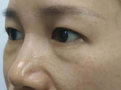 去眼袋手术