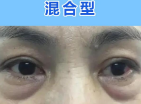 去眼袋手术