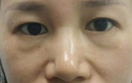 去眼袋手术