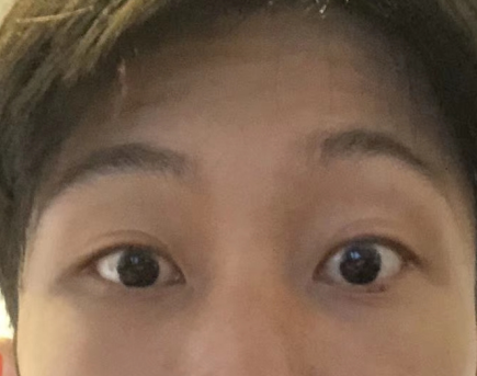 去眼袋手术
