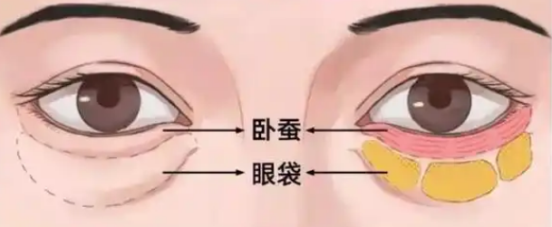 去眼袋手术