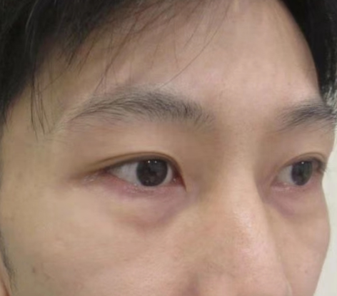 去眼袋手术