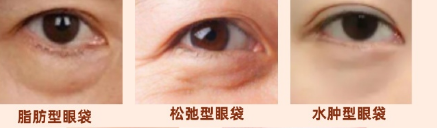 去眼袋手术