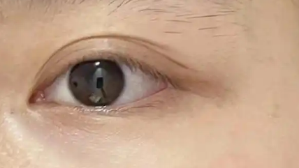 眼袋