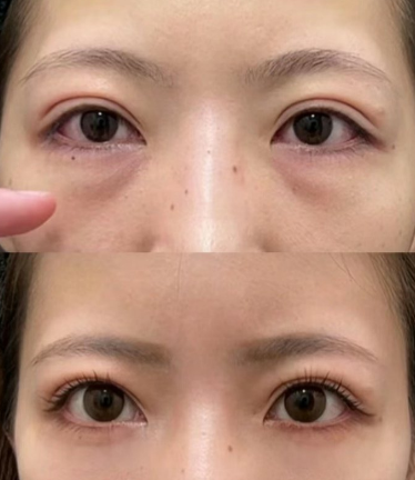 眼袋