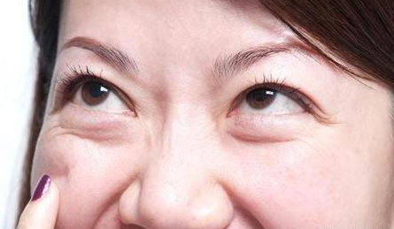 眼袋